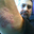 Psoriasis